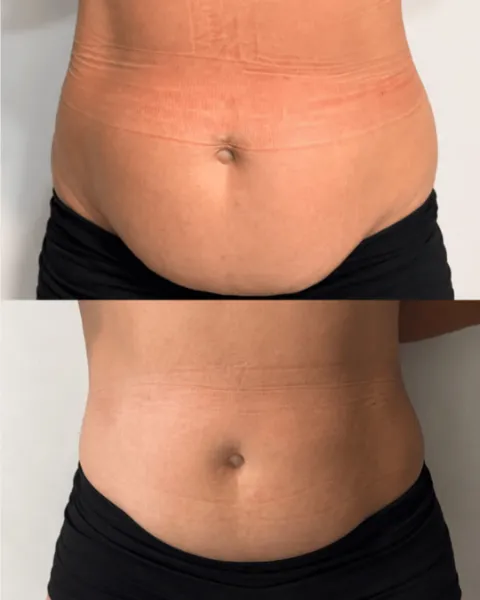 Criolipólise: resultado de paciente da Elyssium Clinic